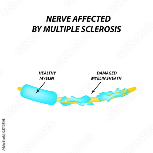The destruction of the myelin sheath on the axon. Damaged myelin. Neuron affected by multiple sclerosis. World Multiple Sclerosis Day. Infographics. Vector illustration on isolated background.