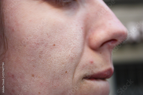 blackheads and large pores. skin care of a teenage Italian girl