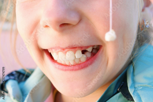 Child pulled out milk tooth with thread.