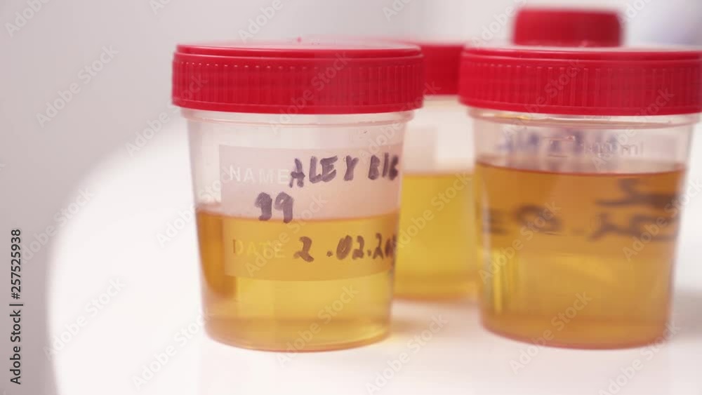A close-up of a hand in medical latex gloves putting a container with urine sample to other samples A close-up of a hand in medical latex gloves putting a container with urine sample to other samples