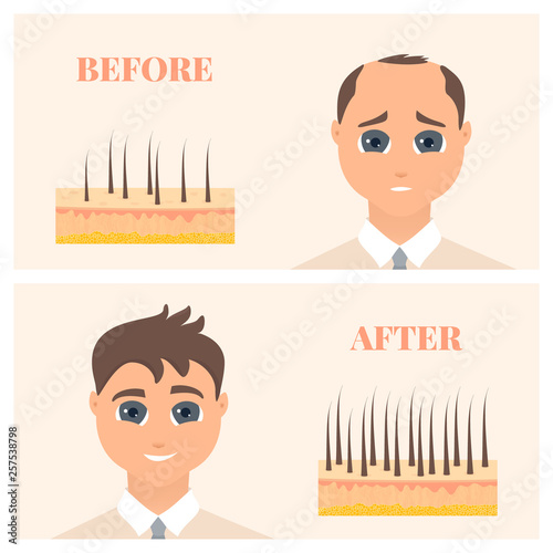 Man suffering hair loss before and after restoration. Male pattern alopecia set with skin cross-section diagram. Before and after result concept. Medical educational poster. Vector illustration. 