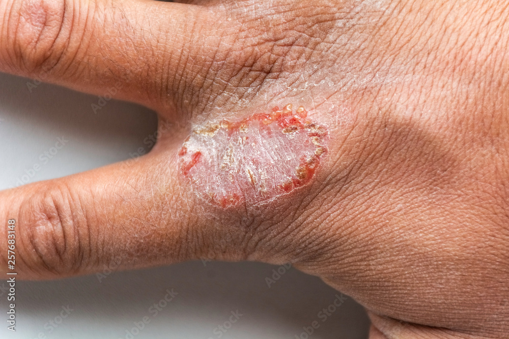 Naklejka premium Hand With Atopic Dermatitis Eczema Psoriasis Vulgaris
