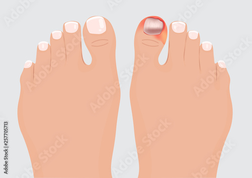 Ingrown Toenail vector illustration