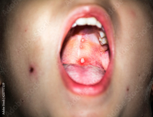 Varicella or Chicken Pox Virus on Soft Palate photo