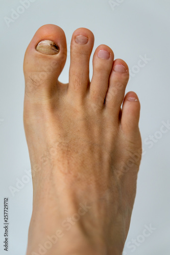 Ugly, sick, injured and broken nail on the foot (fungus on the big toe)