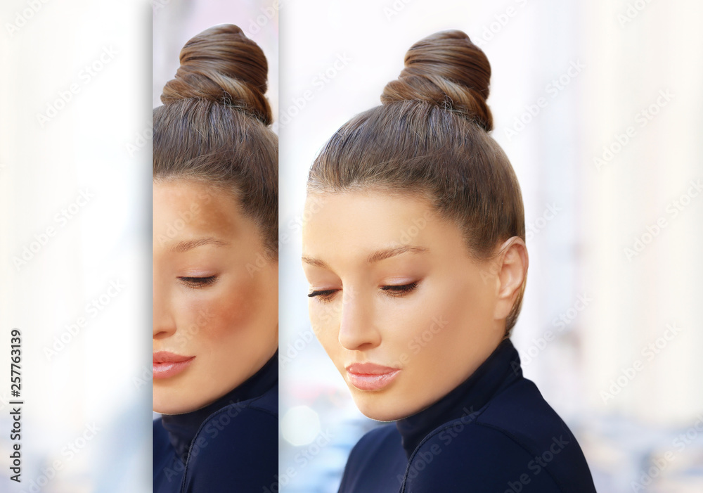 Dark spots, freckles,hyperpigmentation(melasma or chloasma) Dark spots, freckles,hyperpigmentation(melasma or chloasma)