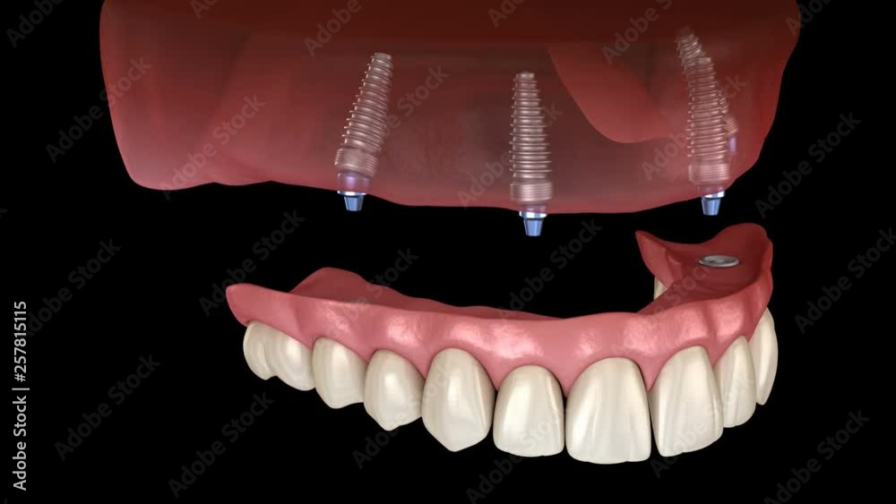 Maxillary Prosthesis Maxillary prosthesis All on 4 system supported by implants. Medically ...