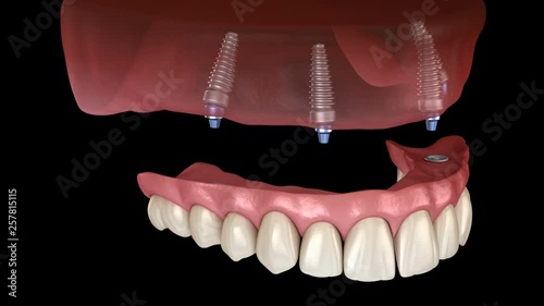 Maxillary prosthesis All on 4 system supported by implants. Medically accurate 3D animation of human teeth and dentures concept
