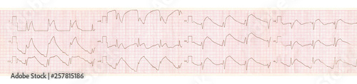 ECG tape with changes in acute pericarditis
