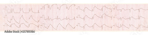 ECG tape with changes in acute pericarditis photo