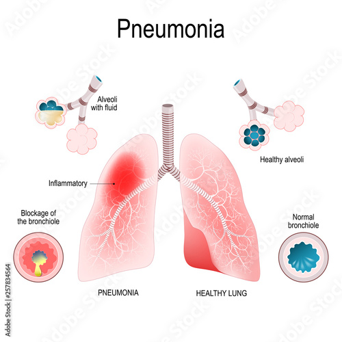 Pneumonia. Difference and Comparison of healthy lungs (bronchioles and alveoli) and pneumonia