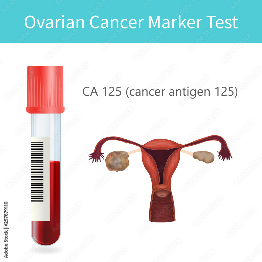 Blood ovarian cancer marker test. CA 125. Uterus, ovary with a tumor.  Vector medical illustration. White background. Stock Vector | Adobe Stock