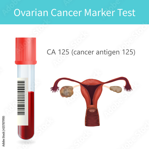 Blood ovarian cancer marker test. CA 125. Uterus, ovary with a tumor. Vector medical illustration. White background.