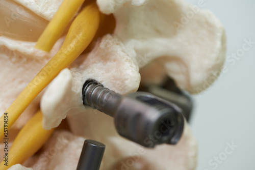Bild auf Leinwand Close-up view of lumbar spine model and instrument fixation