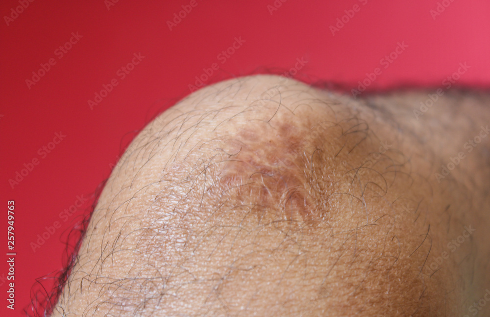 Naklejka premium Close up keloid scar on skin