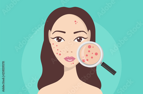 Acne, skin problems, stages of acne. Woman holding magnifying glass for looking cystic acne on her facial. Vector illustration about skin problem concept