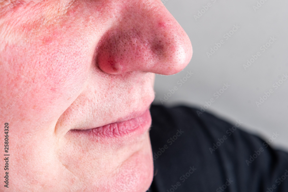 Black dots and acne on the nose.