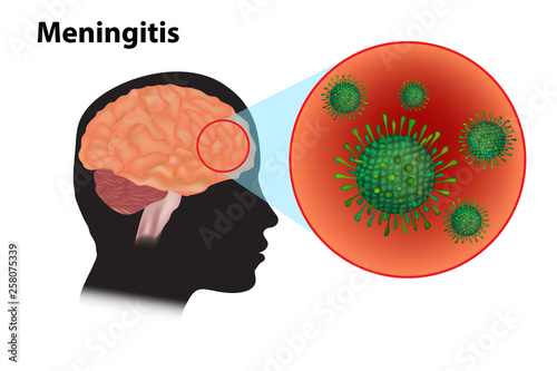 Meningitis - inflammation of the brain. Viral meningitis and encephalitis photo