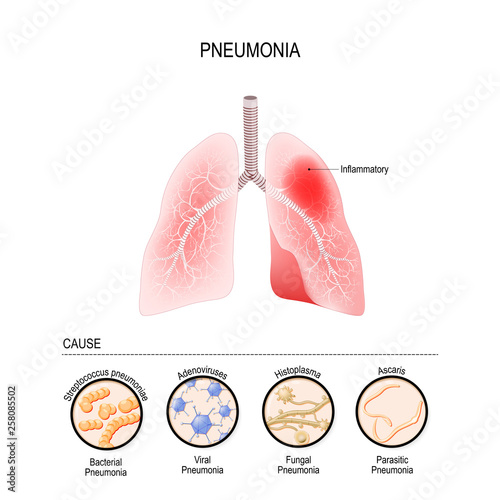 Pneumonia is caused by infection with viruses, bacteria, fungi and microorganism