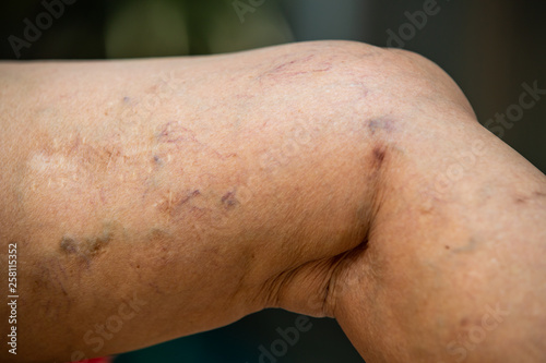 Varicose veins on a leg in Senior women  Close up shot  Selective focus  Asian body skin part  Healthcare concept