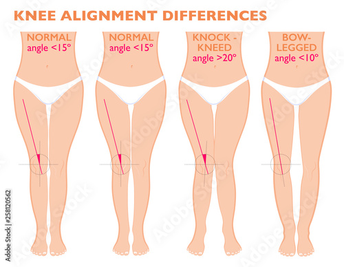 Legs and angles of the knees, different types of leg shapes. Front view girl, body anatomy. Normal varus and valgus