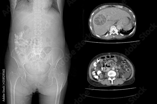 CT whole abdomen show hepatocarcinoma