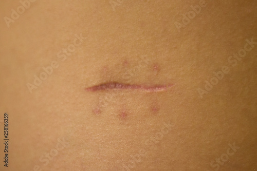 Close up scar on skin