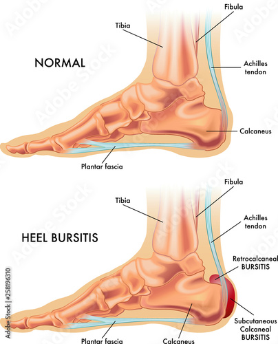 A medical illustration of a healthy foot and a foot affected by heel bursitis.