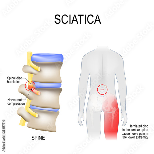 sciatica. scheme with vertebrae, disks and nerves. Human body from back. photo