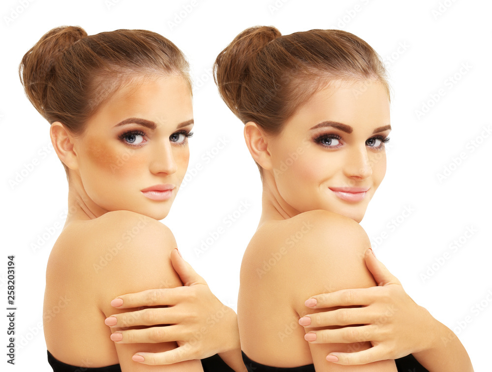 Dark spots, freckles,hyperpigmentation(melasma or chloasma) Dark spots, freckles,hyperpigmentation(melasma or chloasma)