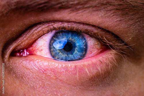 close up of bloodshot eye with red veins