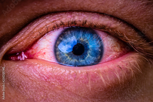 close up of bloodshot eye with red veins