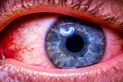 close up of bloodshot eye with red veins