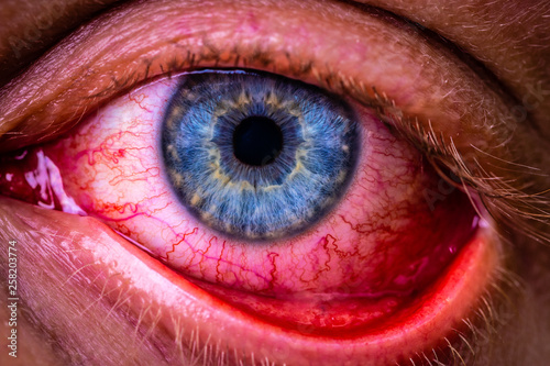 close up of bloodshot eye with red veins