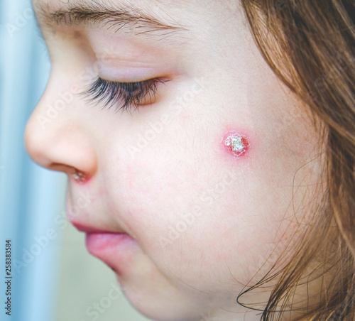 chicken pox spot details face close up spots baby face side cheek