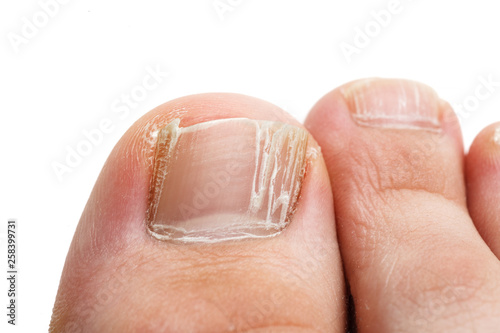 Cracked nails of the toes isolated on white, closeup shot