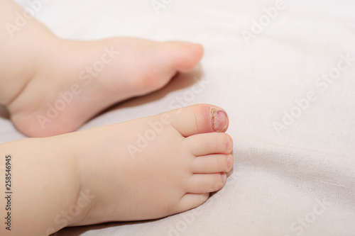 Vászonkép nail inflammation
