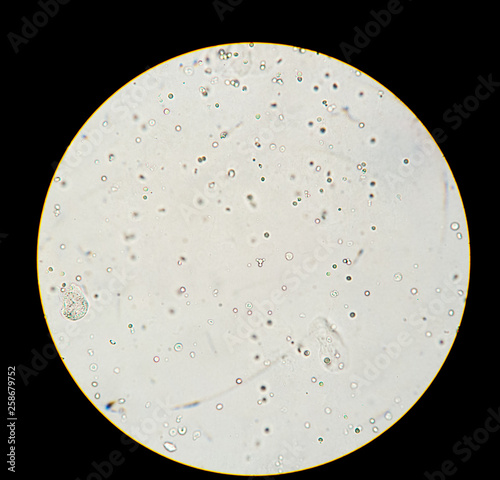 Urinalysis analysis shown crystal under microscopic 