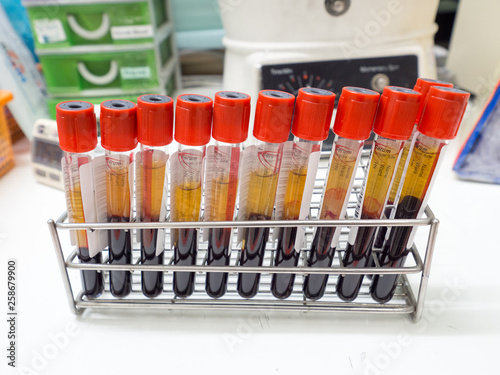 Clotted blood tube for laboratory test