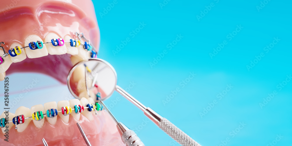 Close up dentist tools and orthodontic model  - demonstration teeth model of varities of orthodontic bracket or brace