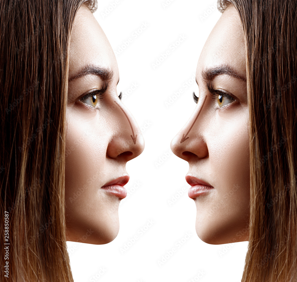 Young woman in profile before and after rhinoplasty. Young woman in profile before and after rhinoplasty.