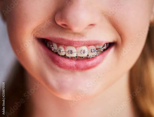 Close up of teeth with braces photo
