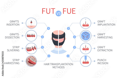 FUE vs FUT medical infographics. Follicular unit extraction versus follicular unit transplantation. Types of hair transplant procedures and their stages. Male alopecia treatment. Vector illustration.