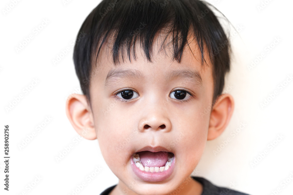 Asian Kid patient open mouth showing cavities teeth decay. unhealthy teeth concept. Asian Kid patient open mouth showing cavities teeth decay. unhealthy teeth concept.