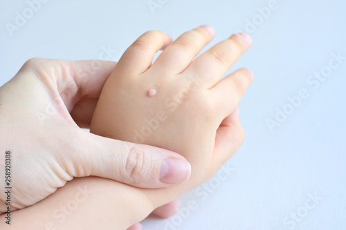 The doctor holds a small hand of a child affected with warts on little fingers and back of the hand. Papillomavirus in a child's hand and fingers. Pediatric dermatology. Skin diseases photo