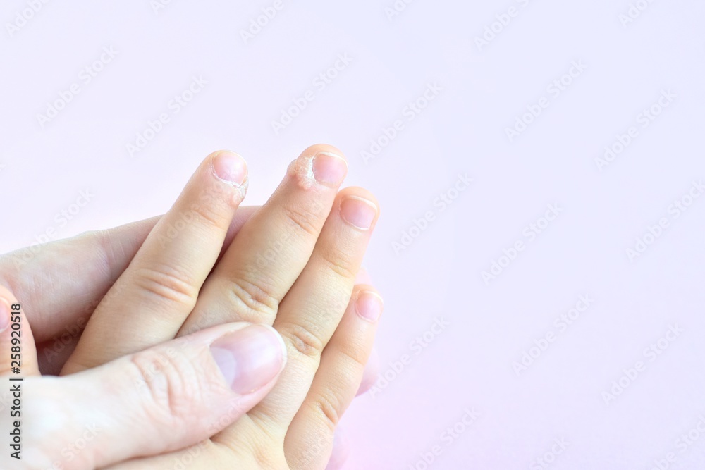 The doctor holds a small hand of a child affected with warts on little