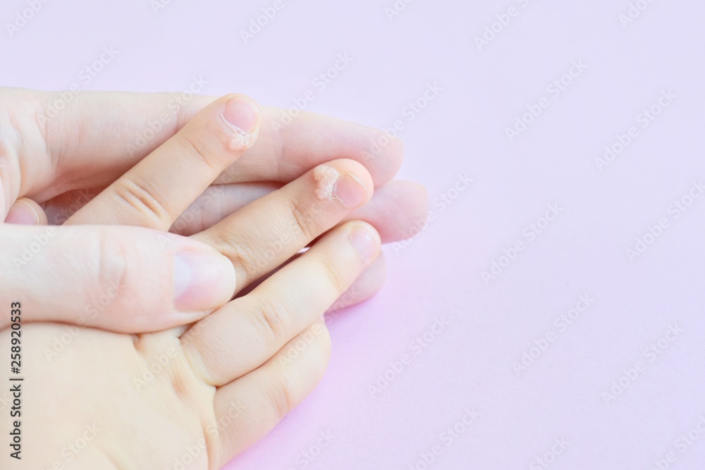 Fotka „The doctor holds a small hand of a child affected with warts on