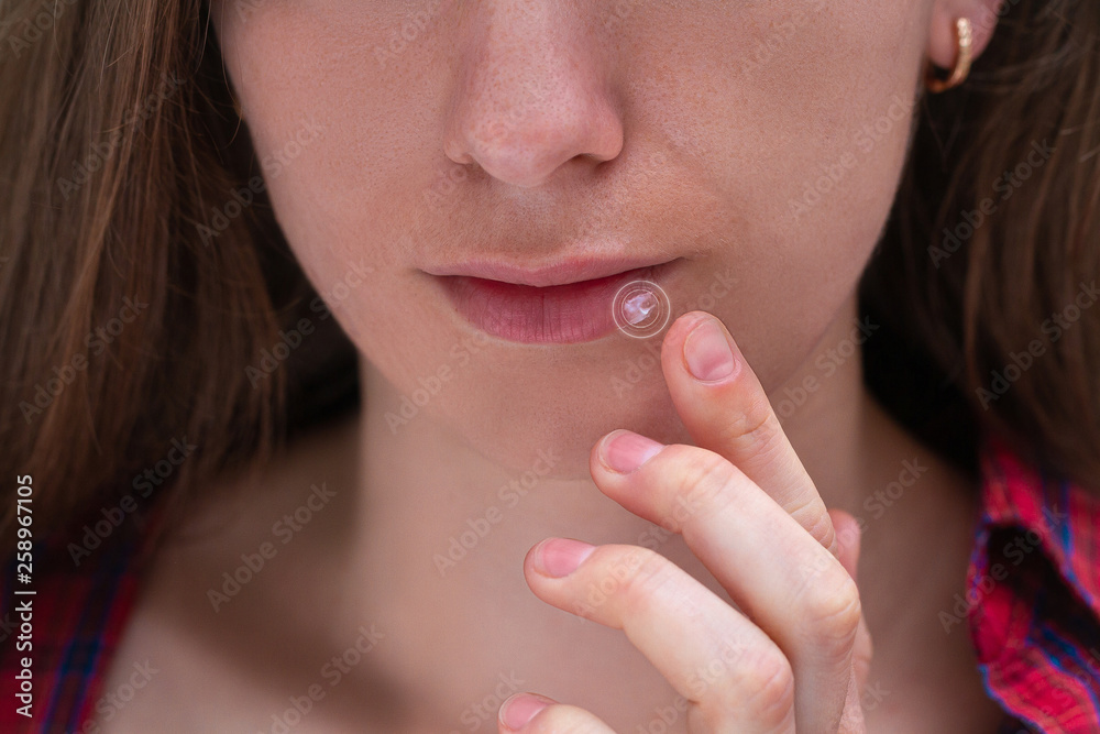 Young woman suffering from herpes on lips. Treatment of herpes infection and virus with ointment Young woman suffering from herpes on lips. Treatment of herpes infection and virus with ointment
