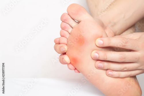 Red and inflamed skin on the sole of the patient s feet, pain from corns and corns with a stem, dry and rough skin, close-up, copy space, dermatology photo