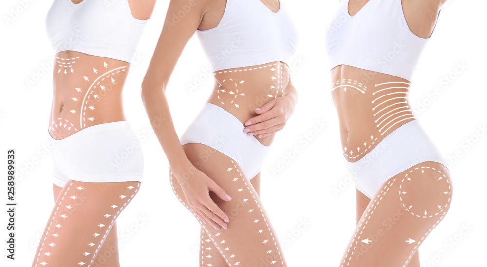 Set of young woman with marks for lifting procedure on white background. Beauty and body care - obrazy, fototapety, plakaty 